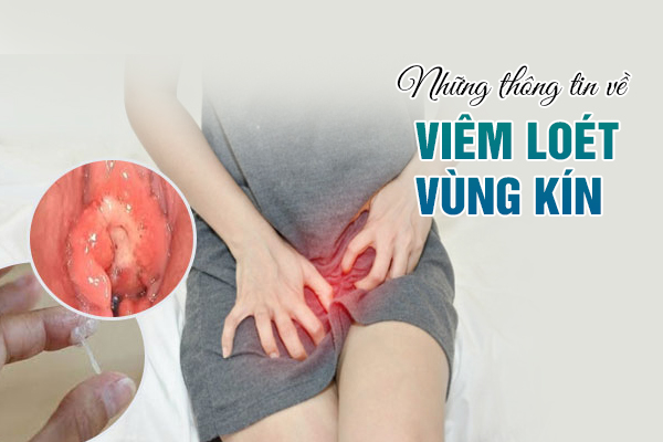 Những thông tin về viêm loét vùng kín