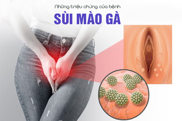 Những triệu chứng của bệnh sùi mào gà